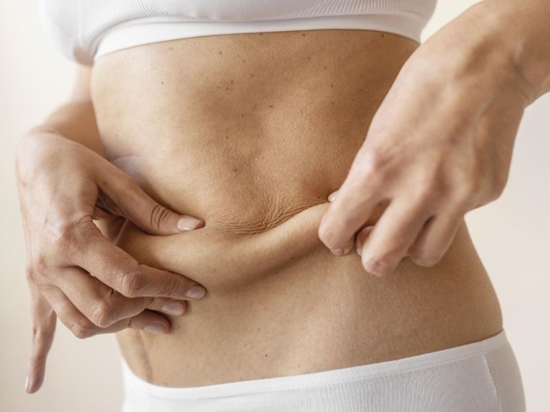 Is Mini Tummy Tuck Suitable for Everyone?