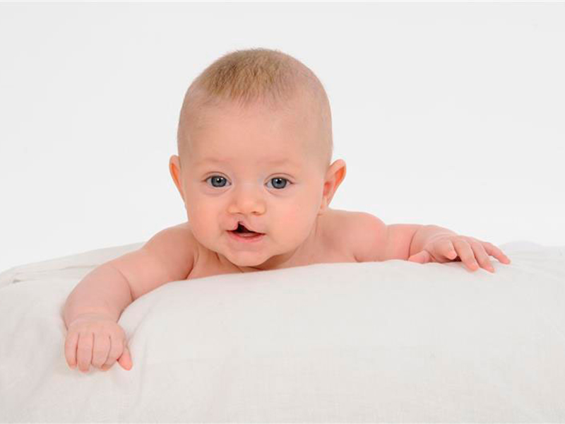 Cleft Lip and Palate