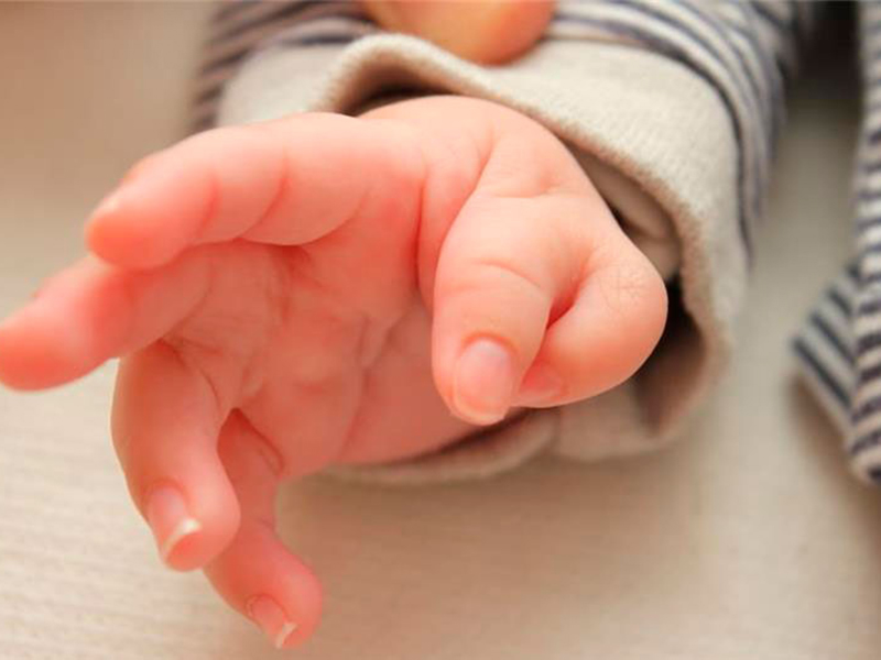 Webbed Fingers (Syndactyly)