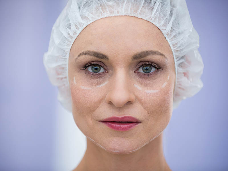 Augenlidstraffung (Blepharoplastik)